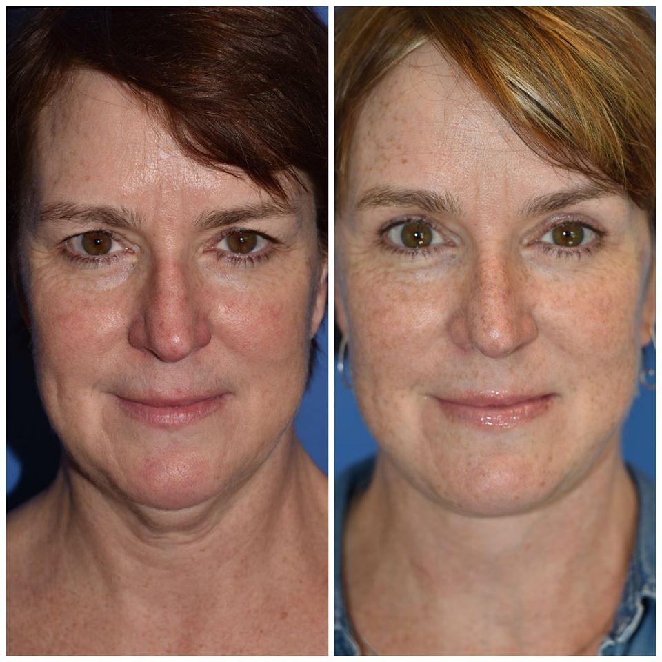 Facelift Surgery Seattle WA